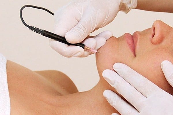 Электроэпиляция в клинике ORLANA BEAUTY